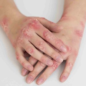 eczema_delphineleterrier